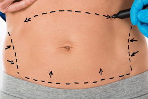 chirurgie-reparatrice-abdominoplastie