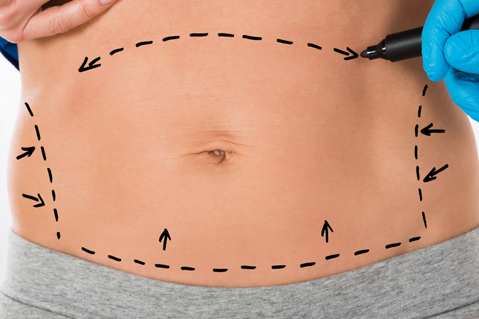 Paroi abdominale - Dr Florence Rampillon Fouquet - Chirurgie ...